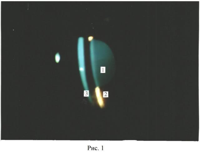 Способ экспериментального моделирования коркового вида катаракты in vivo (патент 2553577)