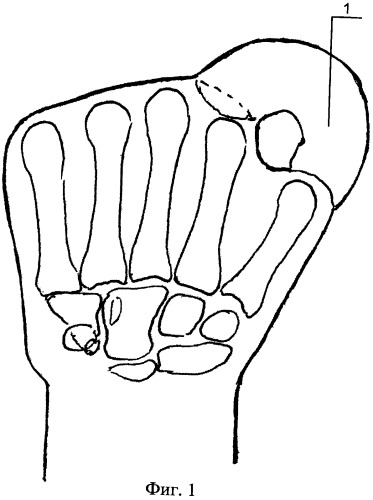 Способ формирования пальца кисти (патент 2460487)
