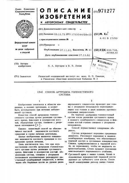 Способ артродеза голеностопного сустава (патент 971277)