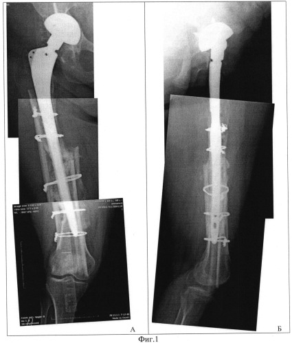 Способ удлинения бедра с установленным эндопротезом (патент 2547780)