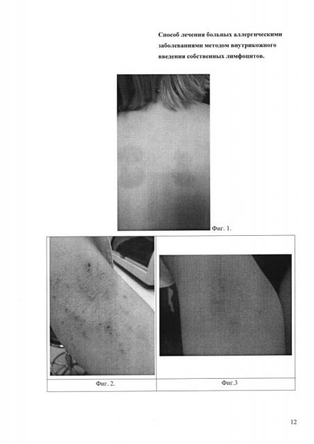 Способ лечения больных аллергическими заболеваниями аутологичными лимфоцитами (патент 2633343)