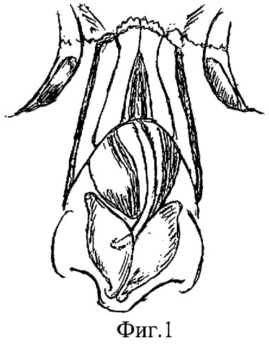 Способ устранения искривления хрящевого отдела спинки носа (патент 2289334)