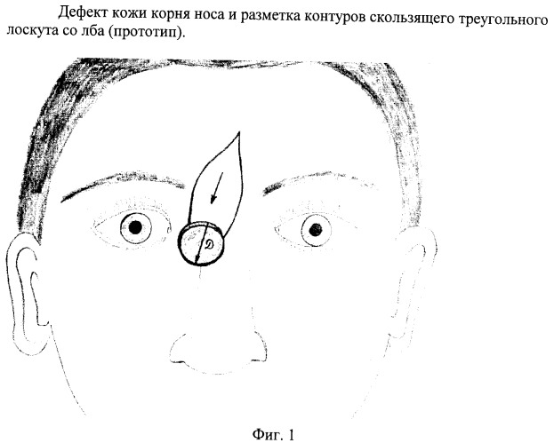 Способ пластики корня носа и медиального угла глаза (патент 2375000)