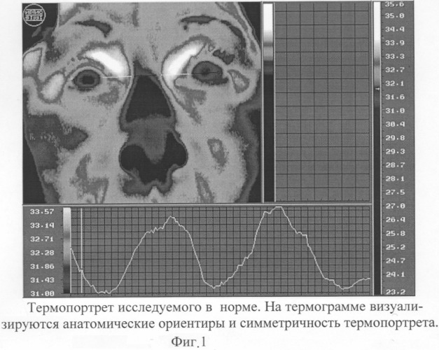 Способ диагностики ишемии зрительного нерва (патент 2299672)