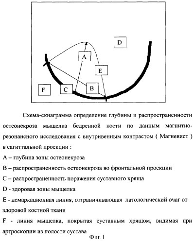 Способ определения глубины и распространенности остеонекроза у пациентов с начальными стадиями рассекающего остеохондрита коленного сустава для проведения артроскопических операций (патент 2284149)