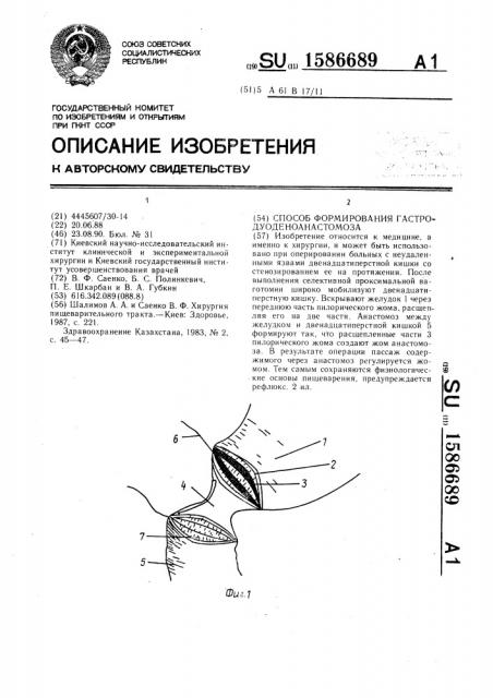 Способ формирования гастродуоденоанастомоза (патент 1586689)