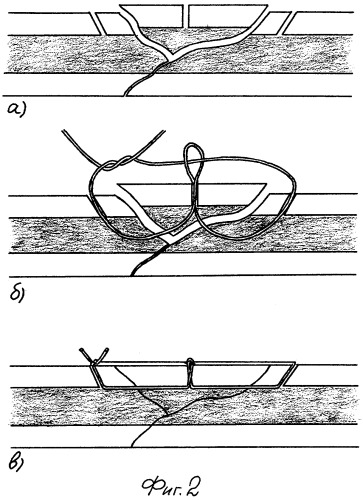 Способ трансоссальной фиксации костного оскола при ретроградном интрамедуллярном остеосинтезе оскольчатых переломов бедра (патент 2275878)