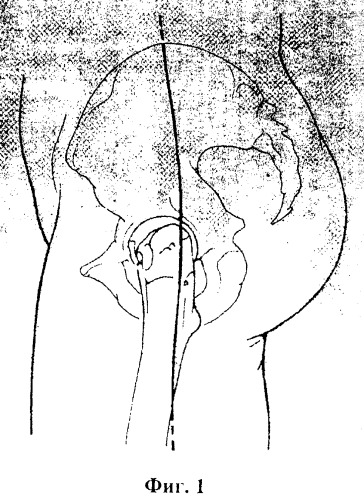 Способ лечения неопорного бедра (патент 2317788)