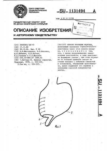 Способ резекции желудка (патент 1131494)