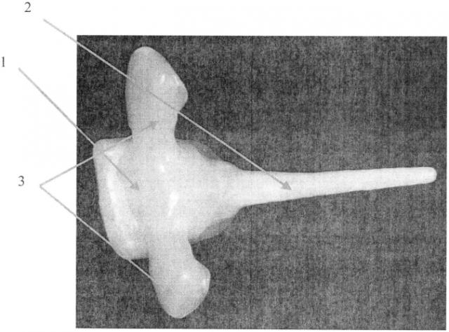 Временный зубной протез-прототип после проведения трансдентальной имплантации (патент 2584556)