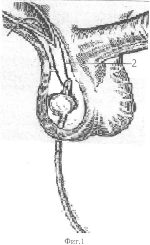 Способ закрытой фиксации яичка в мошонке при орхиопексии (патент 2502476)