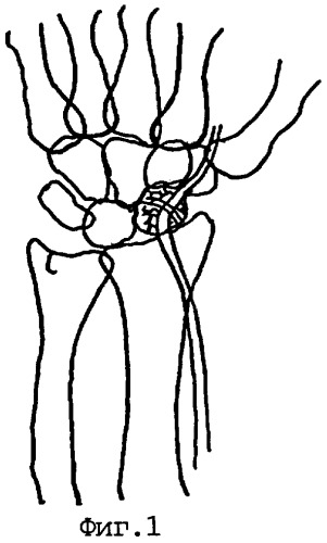 Способ лечения несросшихся переломов и ложных суставов ладьевидной кости запястья (патент 2277879)