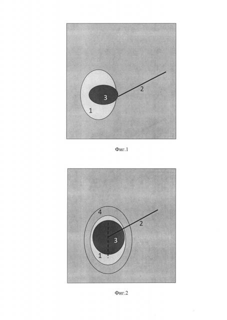 Способ лапароскопической герниопластики (патент 2629249)