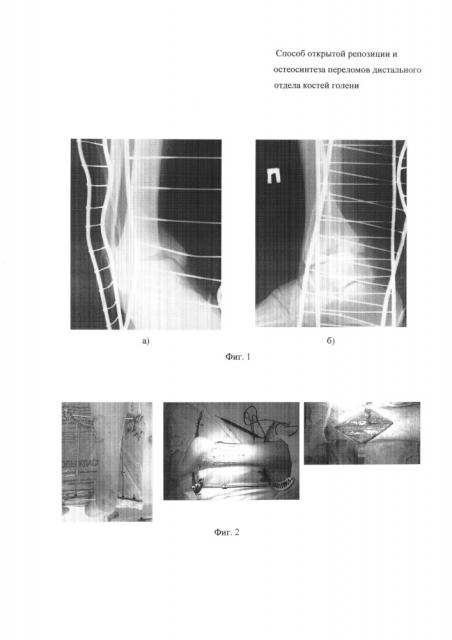 Способ открытой репозиции и остеосинтеза переломов дистального отдела костей голени (патент 2623298)