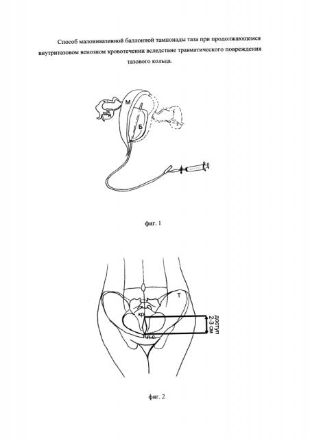 Способ малоинвазивной баллонной тампонады таза при продолжающемся внутритазовом венозном кровотечении вследствие травматического повреждения тазового кольца (патент 2633910)