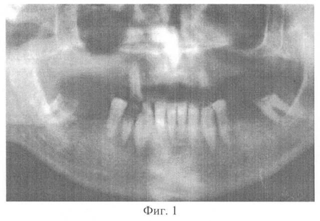 Способ дентальной имплантации верхней челюсти (патент 2266720)