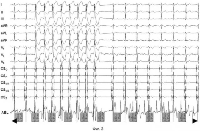 Способ радиочастотной аблации очага эктопической тахикардии в выводном отделе левого желудочка (патент 2428109)