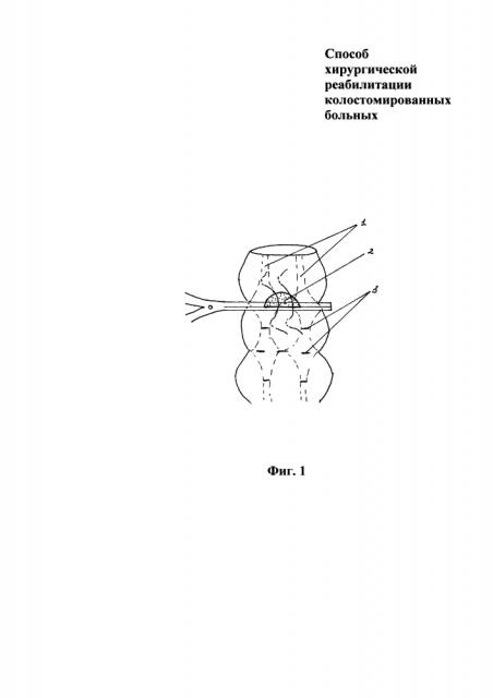 Способ хирургической реабилитации колостомированных больных (патент 2618202)