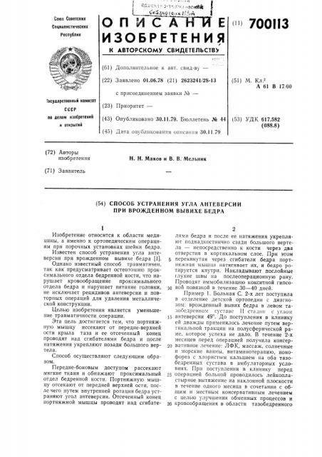 Способ устранения угла антеверсии при врожденном вывихе бедра (патент 700113)
