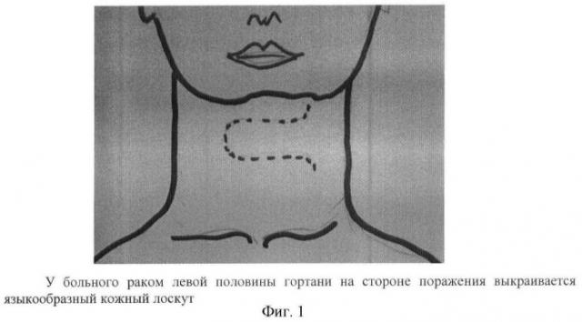 Способ реконструктивной операции на гортани (патент 2463967)