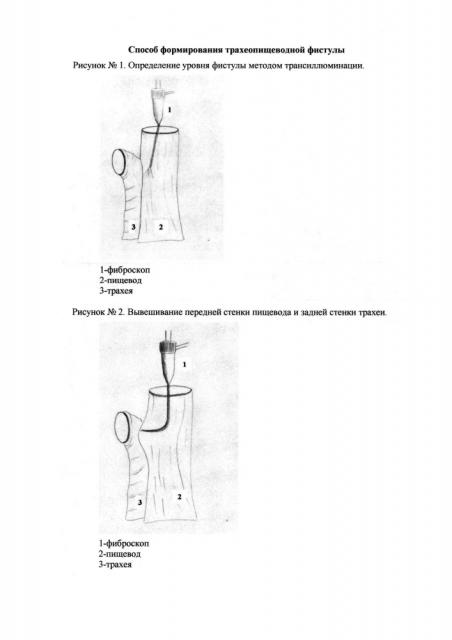 Способ формирования трахеопищеводной фистулы (патент 2634014)