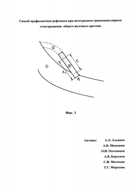 Способ профилактики рефлюкса при антеградном транспапиллярном стентировании общего желчного протока (патент 2652738)