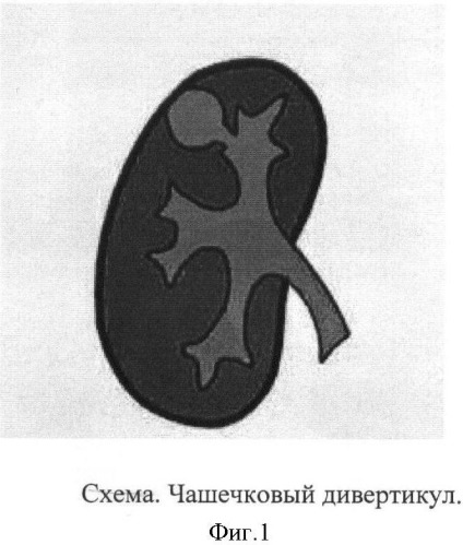 Способ дифференциальной диагностики чашечковых дивертикулов и солитарных кист почек у детей (патент 2411910)