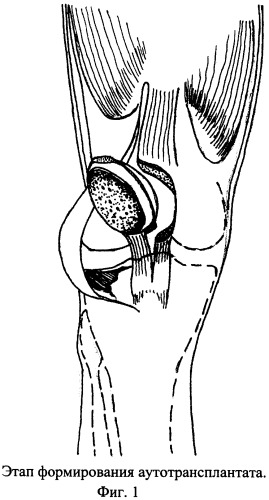 Способ несвободной аутопластики надколенником внутрисуставных дефектов мыщелков большеберцовой кости (патент 2356510)