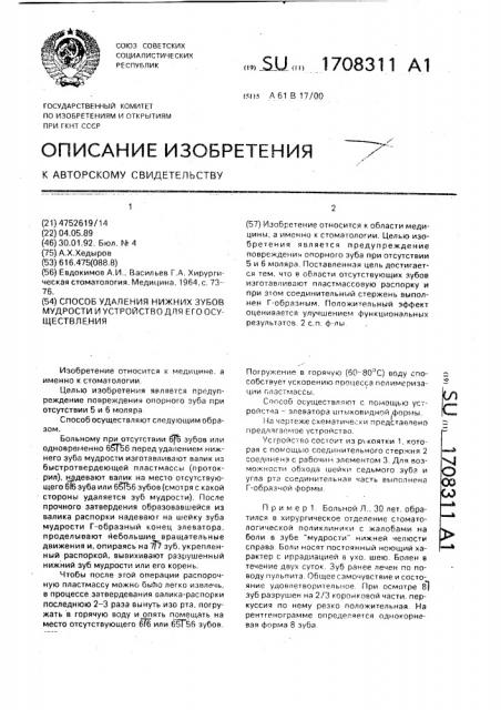 Способ удаления нижних зубов мудрости и устройство для его осуществления (патент 1708311)