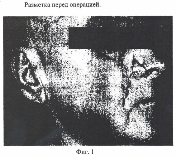 Способ пластики крыла носа (патент 2371124)