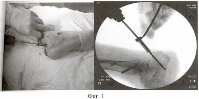 Способ лечения переломов пяточной кости (патент 2440046)