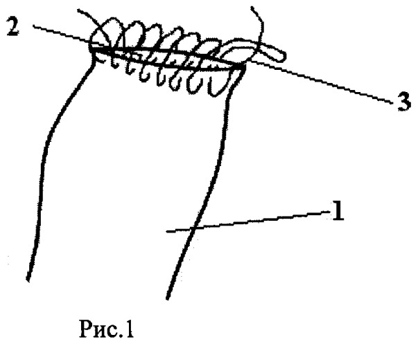 Способ ушивания культи двенадцатиперстной кишки (патент 2522967)