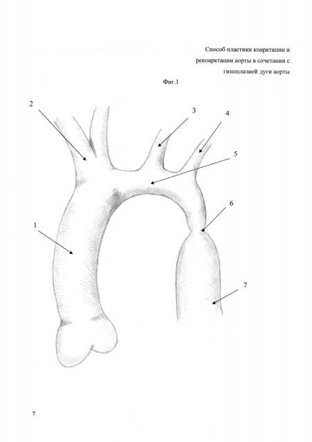 Способ пластики коарктации и рекоарктации аорты в сочетании с гипоплазией дуги аорты (патент 2621953)