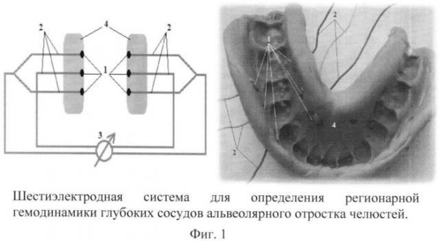 Система электродов для определения регионарной гемодинамики глубоких сосудов альвеолярного отростка челюстей (патент 2546402)