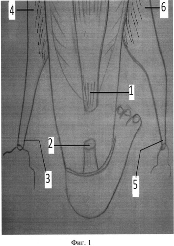 Способ хирургического лечения застарелого разрыва ахиллова сухожилия (патент 2537888)