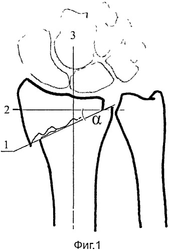Способ диагностики нестабильных переломов дистального метаэпифиза лучевой кости (патент 2525021)