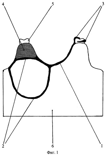 Протез-обтуратор верхней челюсти (патент 2281059)