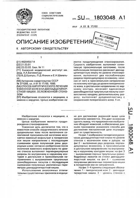 Способ хирургического лечения язвенной болезни двенадцатиперстной кишки, осложненной стенозом (патент 1803048)