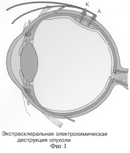 Способ хирургической электрохимической деструкции и фотодинамического лечения внутриглазных новообразований (патент 2243755)