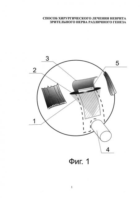 Способ хирургического лечения неврита зрительного нерва различного генеза (патент 2649823)