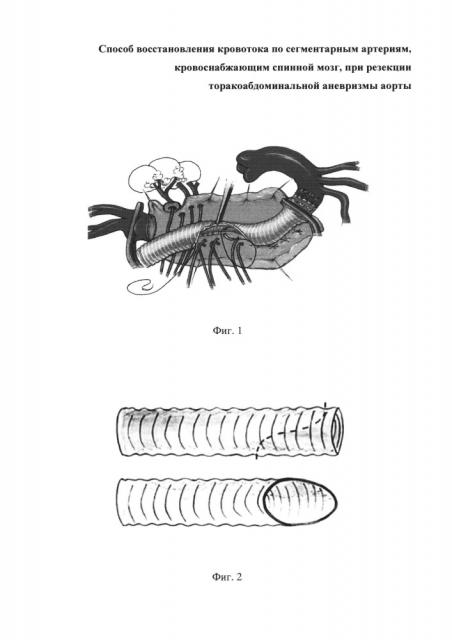 Способ восстановления кровотока по сегментарным артериям, кровоснабжающим спинной мозг, при резекции торакоабдоминальной аневризмы аорты (патент 2652061)