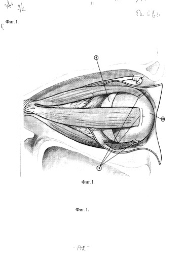Способ формирования опорно-двигательной культи для глазного протеза (патент 2337652)