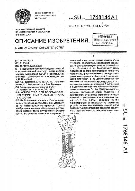 Устройство для восстановления утраченных участков трубчатых костей (патент 1768146)