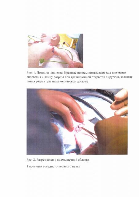 Способ эндоскопической ревизии, невролиза и декомпрессии плечевого сплетения (патент 2637616)