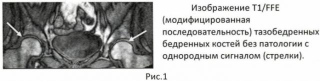 Скрининговый способ диагностики асептического некроза суставных концов костей крупных суставов (патент 2436512)