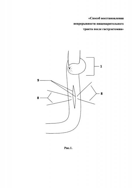 Способ восстановления непрерывности пищеварительного тракта после гастрэктомии (патент 2655980)