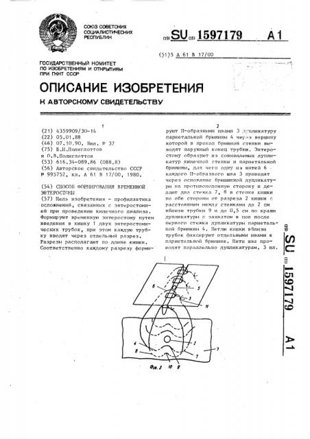 Способ формирования временной энтеростомы (патент 1597179)