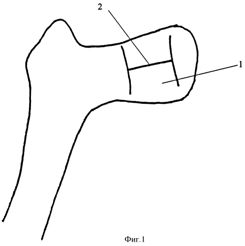Способ капсулопластики тазобедренного сустава у детей с последствиями спинномозговых грыж (патент 2411016)