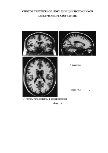 Способ трехмерной локализации источников электроэнцефалограммы (патент 2584086)