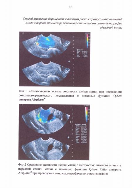 Способ отбора беременных женщин для проведения инвазивной диагностики хромосомных аномалий плода в первом триместре беременности методом соноэластографии сдвиговой волны (патент 2629236)